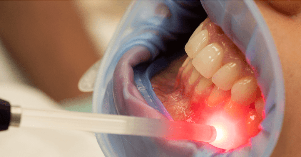 Descubra como o LASER de baixa potência revoluciona o tratamento da osteonecrose dos maxilares. Abordagem eficaz e não invasiva para aliviar sintomas e promover a regeneração óssea.