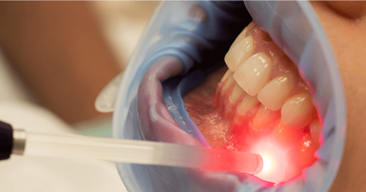 Descubra como o LASER de baixa potência revoluciona o tratamento da osteonecrose dos maxilares. Abordagem eficaz e não invasiva para aliviar sintomas e promover a regeneração óssea.
