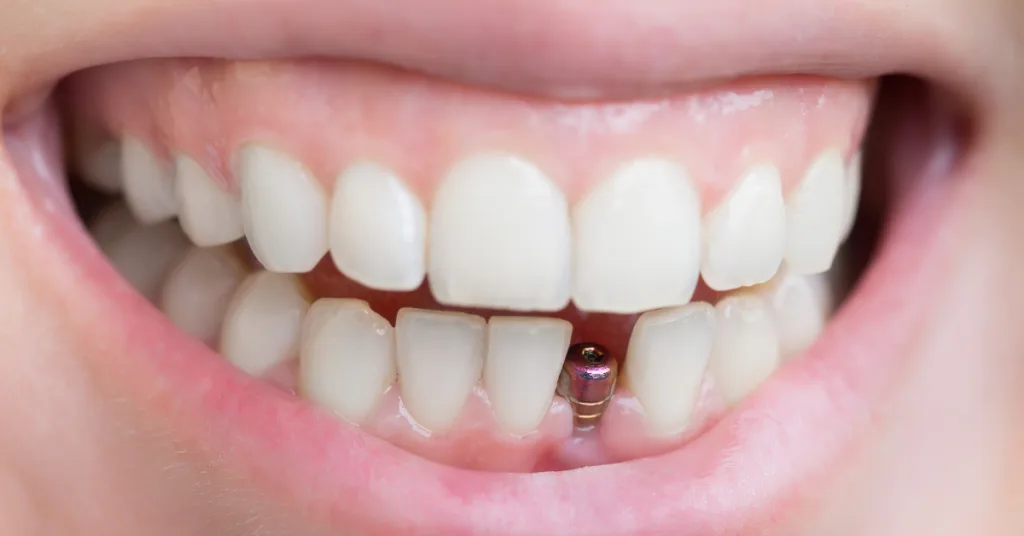 Entenda os riscos da osteonecrose dos maxilares induzida por medicamentos, como o Prolia (denosumab), em cirurgias de implantes dentários e saiba como preveni-los com avaliação especializada.