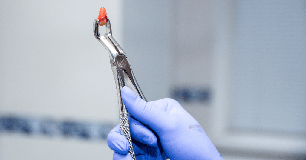 Saiba como a exodontia em pacientes que usam bisfosfonatos pode aumentar o risco de osteonecrose dos maxilares e as condutas para preveni-la. Segurança odontológica em primeiro lugar.