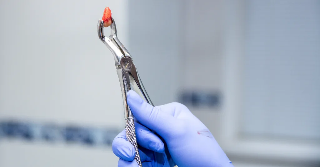 Saiba como a exodontia em pacientes que usam bisfosfonatos pode aumentar o risco de osteonecrose dos maxilares e as condutas para preveni-la. Segurança odontológica em primeiro lugar.