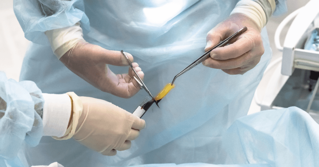 Descubra como o uso de plasma rico em plaquetas na osteonecrose oferece uma abordagem inovadora para a recuperação maxilar. Saiba mais sobre essa terapia eficaz!