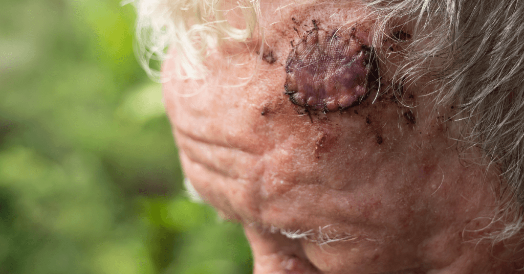 Descubra por que a sedação é uma escolha segura e confortável em cirurgias de câncer de pele na face. Conheça as vantagens da anestesia adequada.