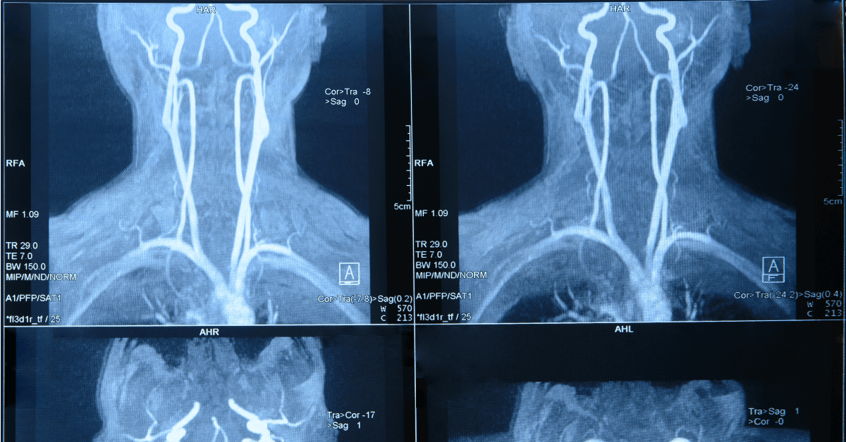 Descubra o que é a angiografia das cervicais, quando é indicada, seus benefícios e riscos. Saiba como é realizada de forma segura.