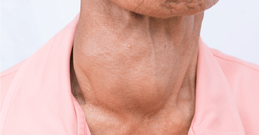 Descubra o que é o bócio, suas causas, sintomas e opções de tratamento. Saiba como prevenir problemas na glândula tireoide.