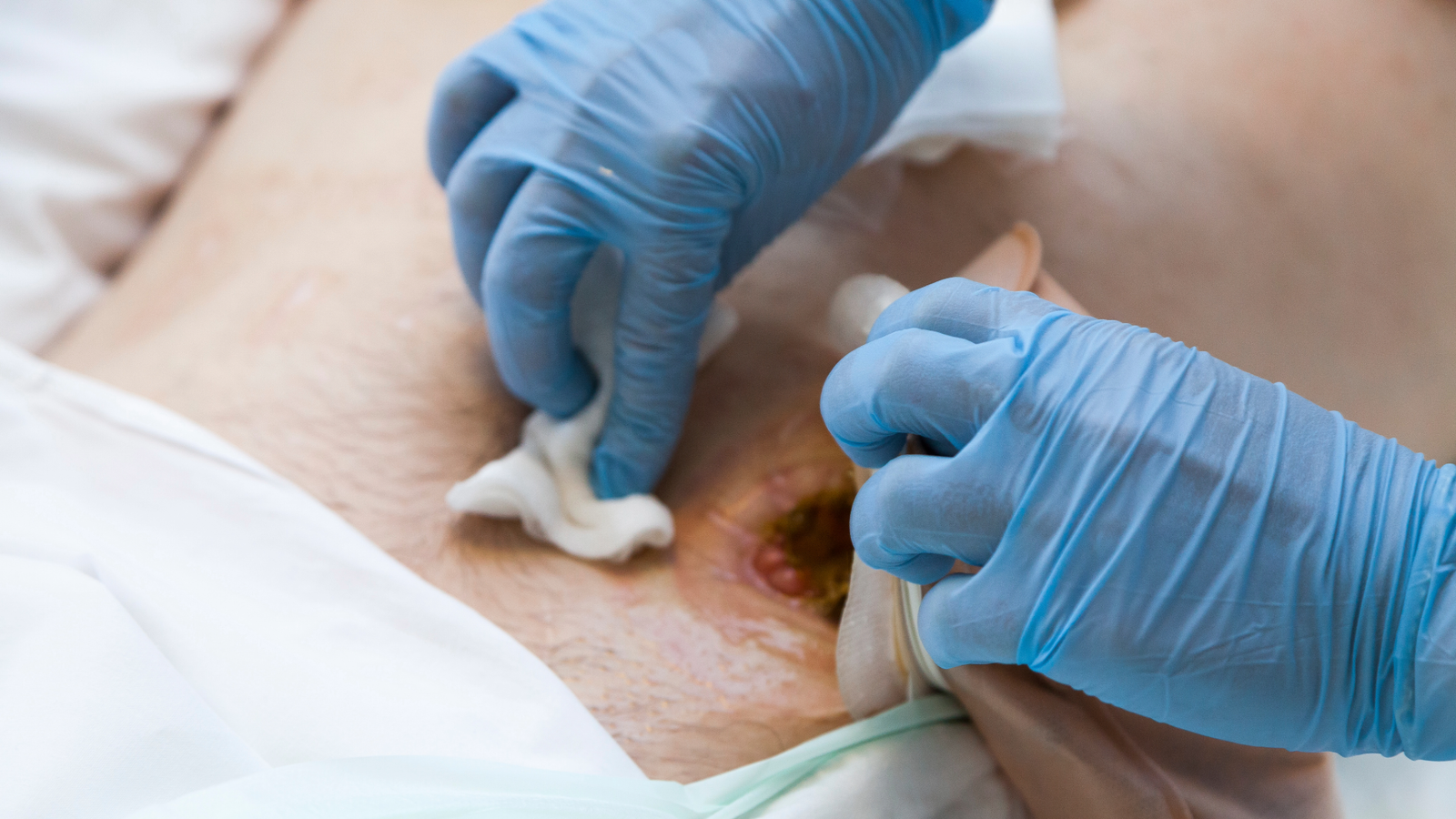 Descubra o que é a reversão de colostomia, como funciona, possíveis complicações e dicas para uma recuperação tranquila após a cirurgia.